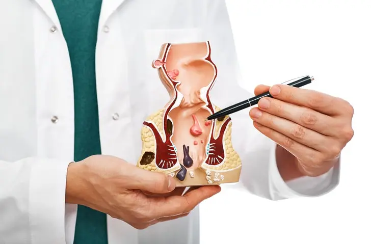 Painless solutions with hemorrhoid treatment with laser in Tehran